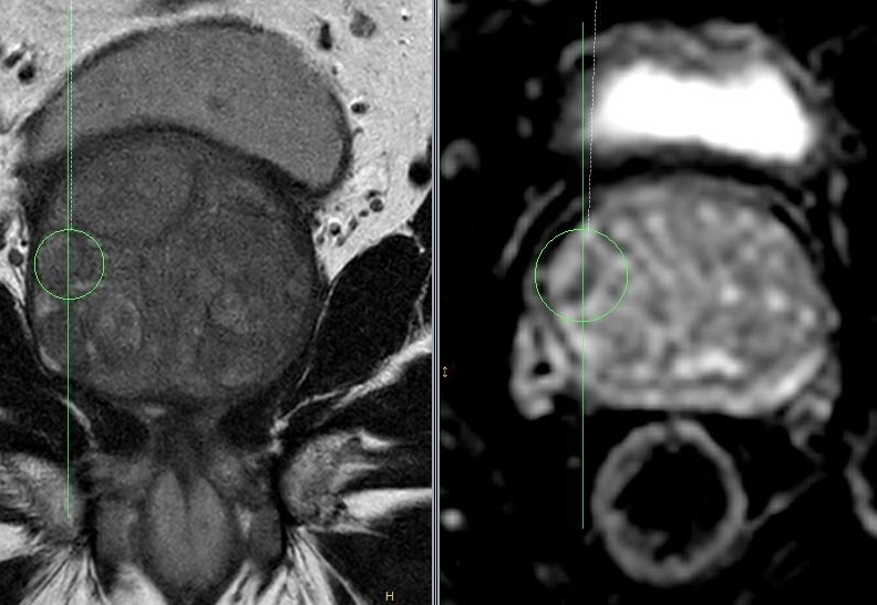 mpMRT Prostata mit MRT Fusionsvorbereitung_Urologie_Amriswil