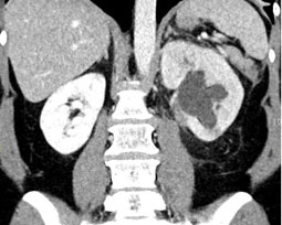 Computertomografie der Nierenbeckenabgangsenge