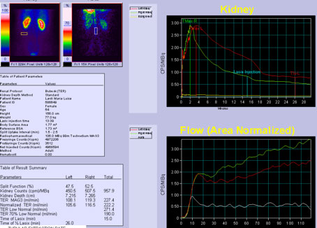 Nierenfunktionsprüfung (Fachausdruck: Isotopennephrografie) einer Nierenbeckenabgangsenge links