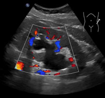 Ultraschallbild einer Nierenbeckenabgangsenge