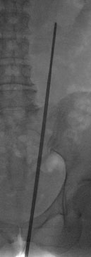 starres Endoskop im Nierenbecken zur Probenentnahme